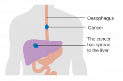 Esophageal cancer - Wikipedia