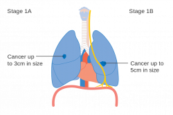 Non Small Cell Lung Cancer – Radonc – Medium