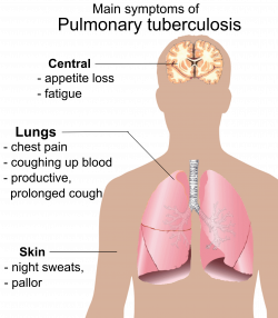 tuberculosis symptoms - Google Search | Step 2 Maloooooo | Pinterest