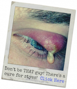 Styes Treatment, Symptoms, Causes, Prevention (Eye Sty Cyst Boil)