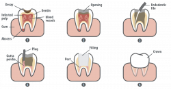 Root Canal in Marrero LA | What is a Root Canal Procedure