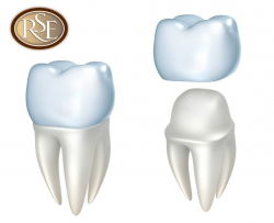 The Factors Used to Determine the Placement of Dental Crowns ...