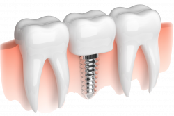 Dental implants are used to restore missing teeth. But unlike ...