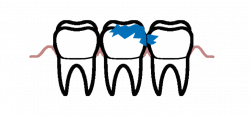 Dental Decay Treatment – Dentoralmax