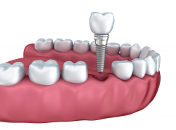 Dental Implant Surgery Recovery - Wichita, KS - Nordhus ...