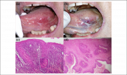 a) Speckled leukoplakia-like lesion located on the left tongue ...