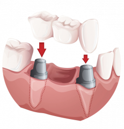 Multiple Dental Implants | Maryland Implant Center