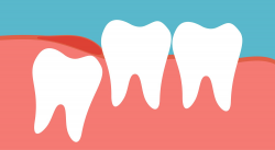 Wisdom Teeth Coming In? What You Need to Know