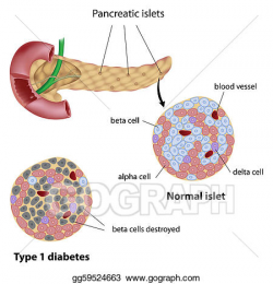 Vector Stock - Pancreatic islet in diabetes, eps8. Clipart ...