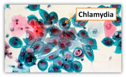 4 Steps To Prevent Chlamydia - by Justin Tang [Infographic]