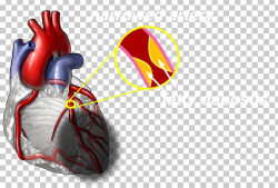 Coronary Artery Disease Heart Cardiovascular Disease ...