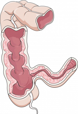 Colon (Crohn's disease) - Servier Medical Art - 3000 free medical images