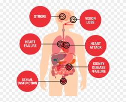 Fail Clipart Health Risk - High Blood Pressure Effects, HD ...