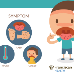 Hand foot and mouth disease is viral infection that causes ...