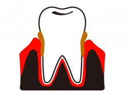 Dental plaque | Calculus | Periodontal plaque | Periodontal disease ...