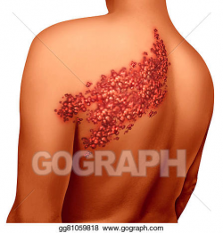 Drawing - Shingles disease. Clipart Drawing gg81059818 - GoGraph