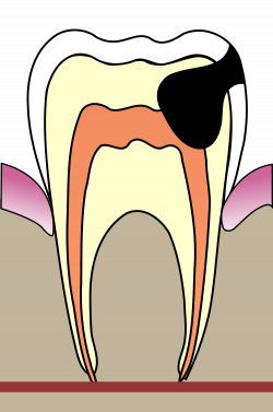 File:Cavities evolution 4.svg - Wikimedia Commons