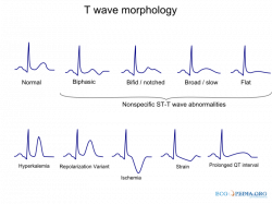 How to read an ECG - wikidoc