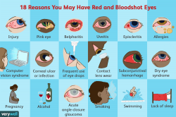 Red Eyes - Reasons for Bloodshot Eyes