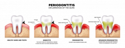 Periodontology, Periodontitis | Dental treatments in Budapest ...