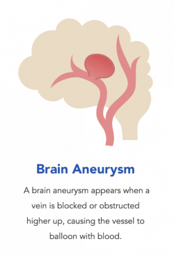 What is The Difference Between An Aneurysm And A Stroke? | Saebo