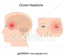 Vector Illustration - Cluster headache, eps10. EPS Clipart ...