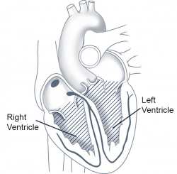 Ventricular Tachycardia | Cleveland Clinic