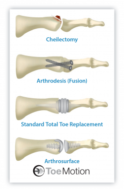 toe fusion | Foot surgery. | Pinterest | Surgery and Arthritis