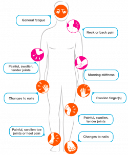 Symptoms of PsA | Psoriatic Arthritis