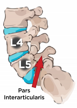 Have an L4-L5 Pars Defect in Your Spine? It Might be ...