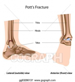 Clip Art Vector - Pott's fracture, eps8. Stock EPS ...