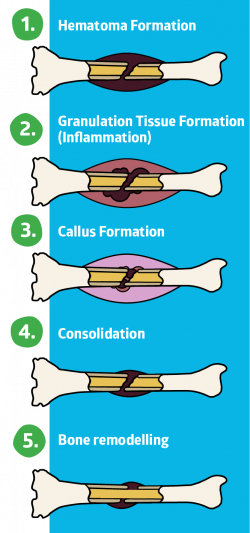 Bone Fracture Healing Supplements - Do They Work? | AlgaeCal