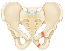 Pelvic Fractures - OrthoInfo - AAOS