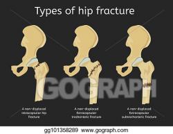Vector Art - Types of hip fracture. Clipart Drawing ...