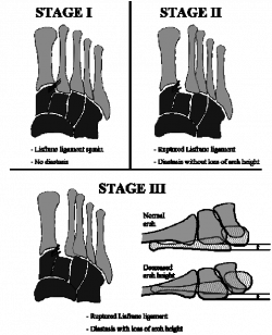 Diagram illustrating Nunley et al.'s classification of midfoot ...