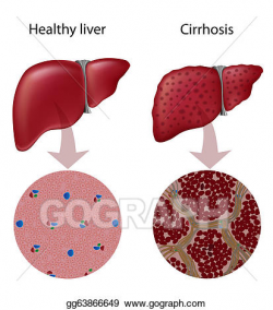 EPS Illustration - Liver disease cirrhosis, eps10. Vector ...