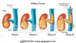 Vector Clipart - Kidney cancer. Vector Illustration ...
