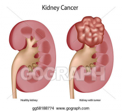 Vector Illustration - Kidney cancer. Stock Clip Art ...