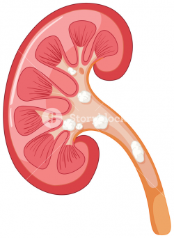Diagram of kidney having problem illustration Royalty-Free ...