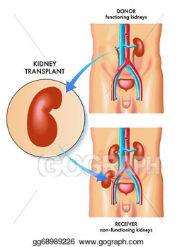 Clip Art Vector - Kidney transplant. Stock EPS gg68989226 ...