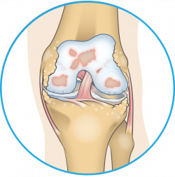 Bone spurs in the knee - Everything you need to know and more -