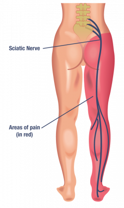 What is Sciatica? – Central Coast Spinal Care Centre