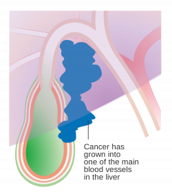 File:Diagram showing stage T4 gallbladder cancer CRUK 437.svg ...