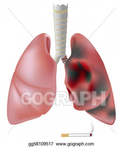 Vector Art - Smoker's vs. healthy lung. Clipart Drawing ...