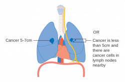 Non Small Cell Lung Cancer – Radonc – Medium