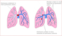 Pulmonary Embolism Misdiagnosed – A case study