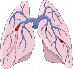 Pulmonary embolism - Servier Medical Art - 3000 free medical images