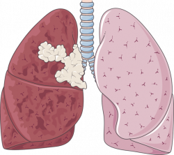 Lung Cancer Cartoon Images | Cartoonview.co