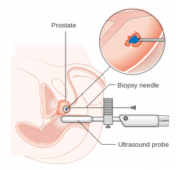 Prostate biopsy - Wikipedia