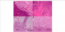 Histopathological findings at the interface between the tumor and ...